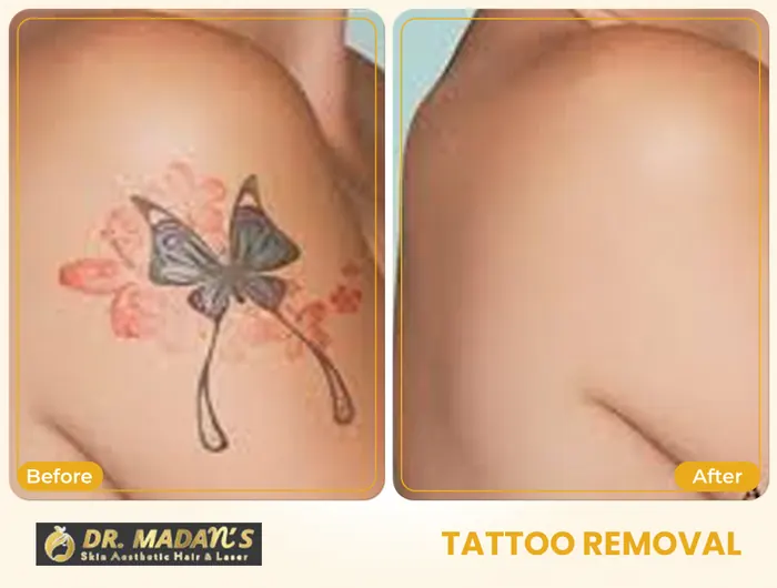 Tattoo removal before and after result 9 at Dr Madan Aesthetics